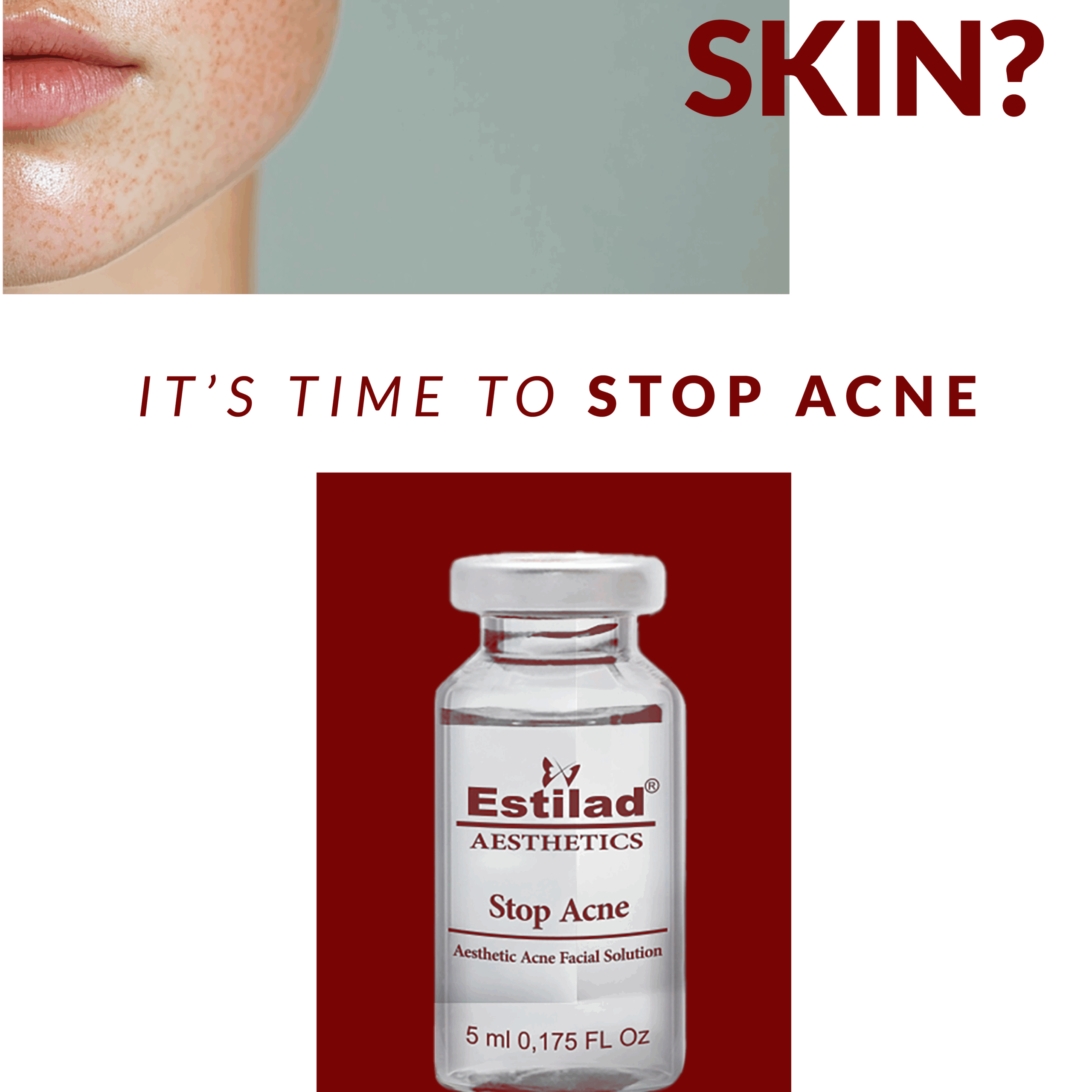 Stop Acne